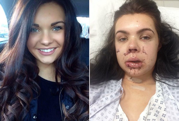 A dançarina, de 21 anos, em fotos antes e depois do ataque: segundo mãe, ela só consegue se alimentar de líquidos (Foto: Facebook e The Grosby Group)