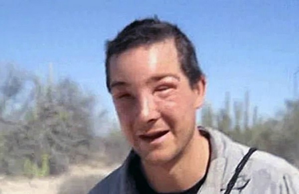 Reação alérgica de Bear Grylls à picada de abelha em 2008, na gravação de 'Born Survivor' (Foto: Reprodução / YouTube)
