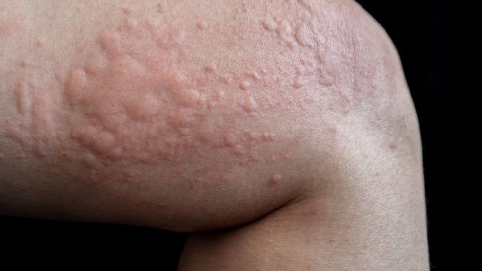 Alergia/urticária — Foto: Getty Images via BBC