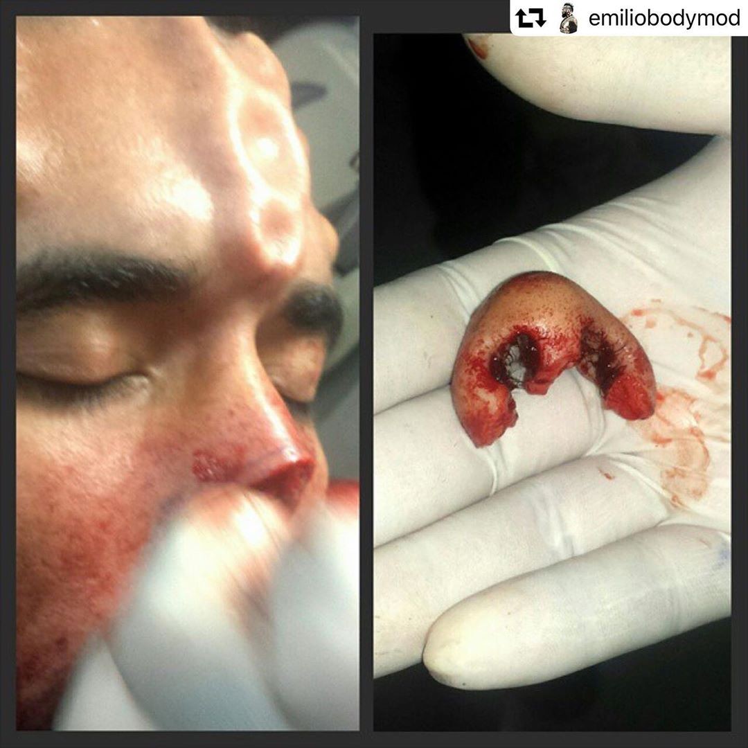 Henry exibe parte de seu nariz amputada em cirurgia (Foto: reprodução instagram)