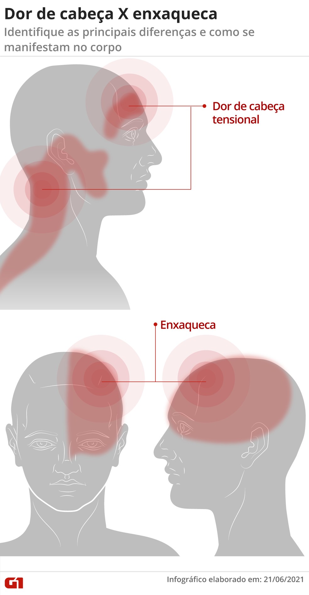 A dor sentida durante as crises de enxaqueca e de dor de cabeça tensional são em locais diferentes — Foto: Arte G1