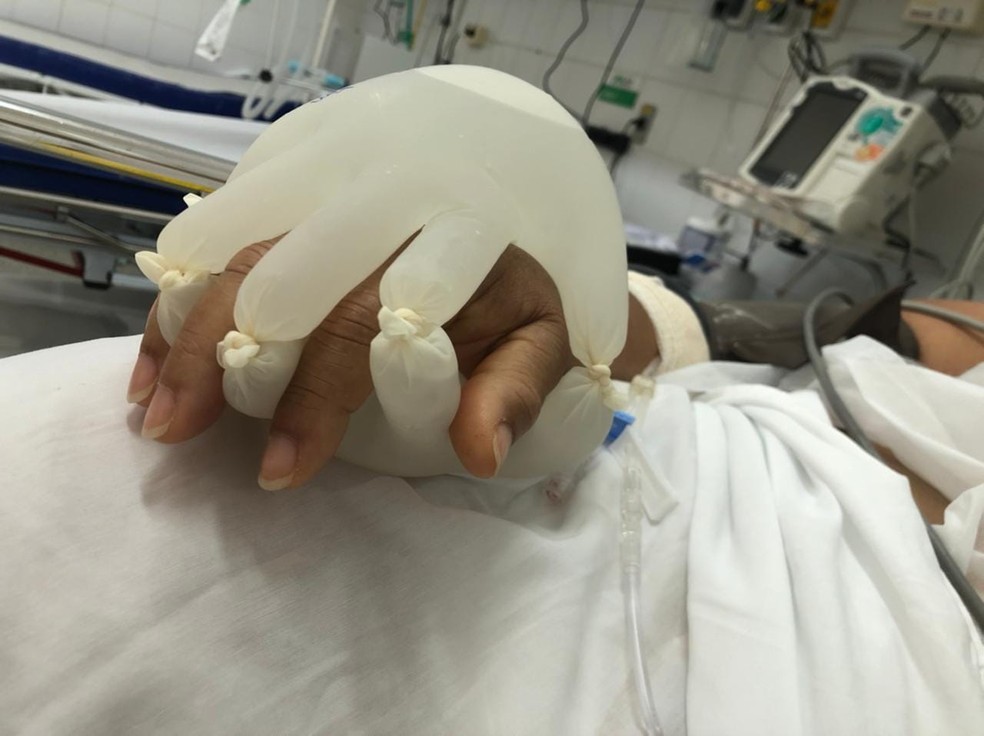 Técnica em enfermagem ampara mão de paciente intubada por Covid-19 com luvas cheias de água morna — Foto: Semei Araújo Cunha