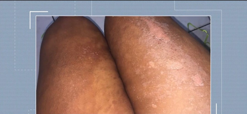 Quatro mulheres denunciam ter sofrido queimaduras apÃ³s serviÃ§o de bronzeamento natural com fitas em clÃ­nica â€” Foto: ReproduÃ§Ã£o/TV Santa Cruz