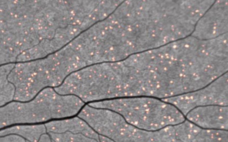 Depósitos amiloides marcados com curcumina ganham destaque em uma varredura da retina (Foto: NeuroVision)