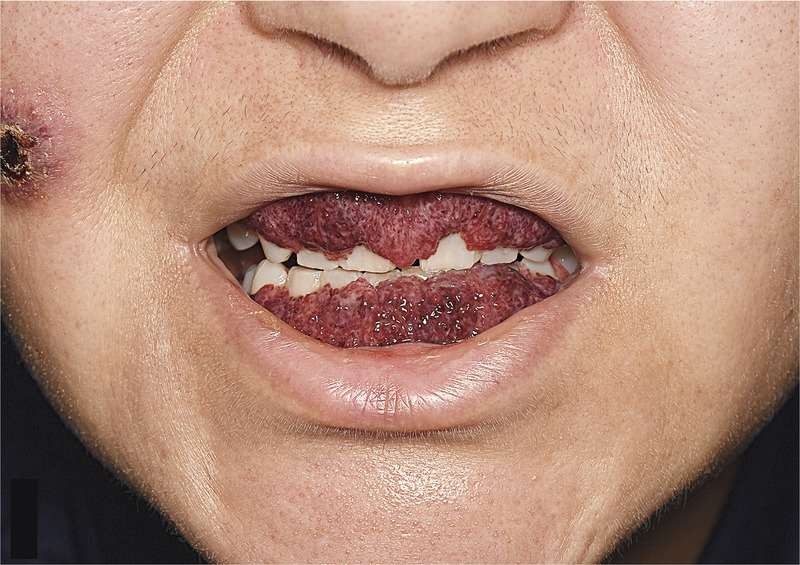 severe calculus buildup in mouth