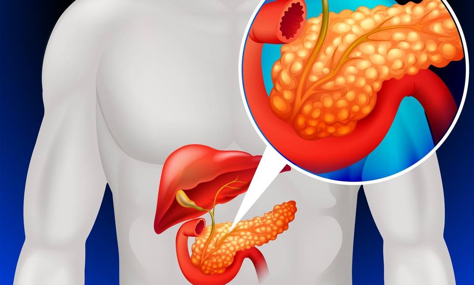 Sintomas do câncer de pâncreas não são específicos, mas podem dar um sinal de alerta precoce.