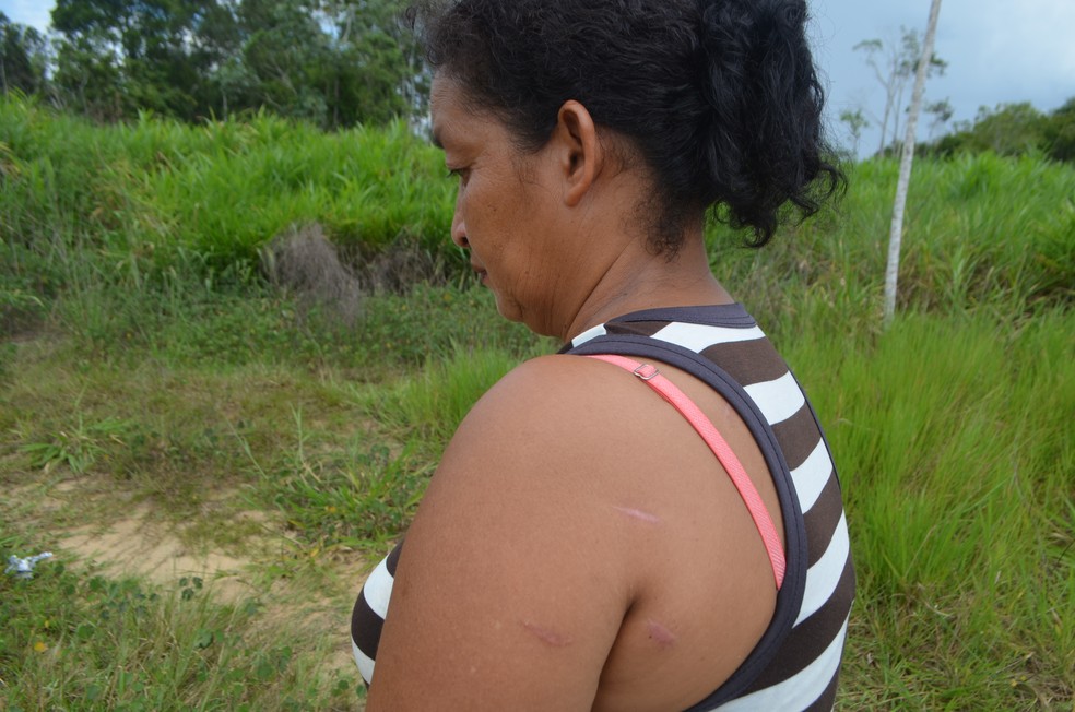 Marcas estão por todo o corpo da dona de casa que foi ferida por 15 facadas  (Foto: Anny Barbosa/G1)
