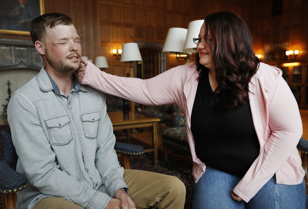 Lilly Ross toca o rosto de Andy Sandness, que tem transplantaram o rosto de seu marido (Foto: Charlie Neibergall/AP Photo)