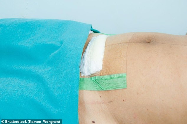 Mulheres estão removendo seus curativos para fazer fotos da cicatriz da cesárea (Foto: Shutterstock)