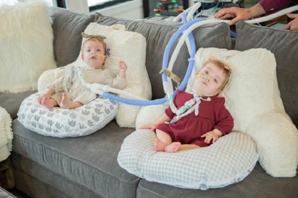 As gêmeas estão se recuperando em casa (Foto: Reprodução Today Parents/Children's Hospital of Philadelphia)