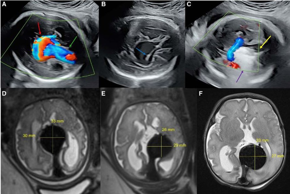 Ultrassom intraprocedimento e ressonância magnética (RM) pré e pós-procedimento cirúrgico no cérebro do feto