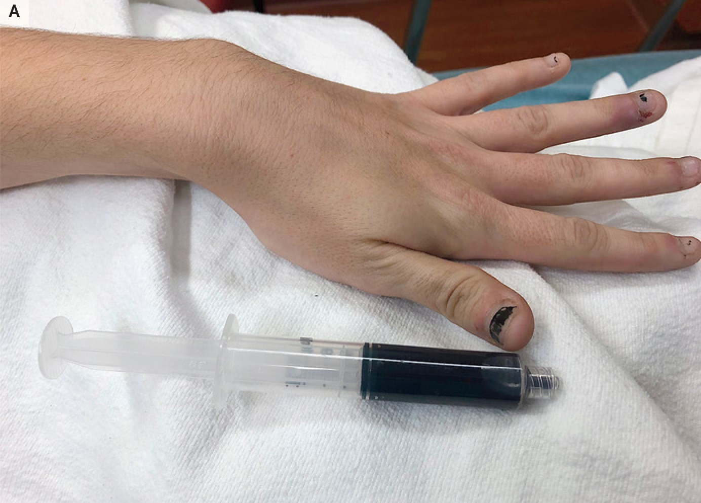 Até as unhas da mulher ficaram azuladas  (Foto: The New English Journal Of Medicine )