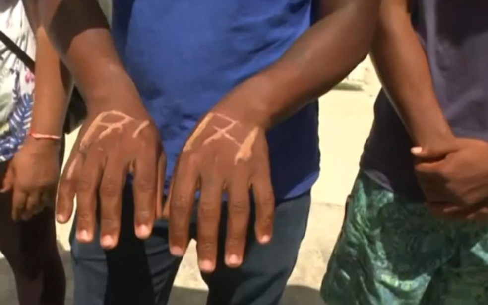 Vítima teve mãos queimadas por ex-chefe na Bahia — Foto: Reprodução/TV Bahia