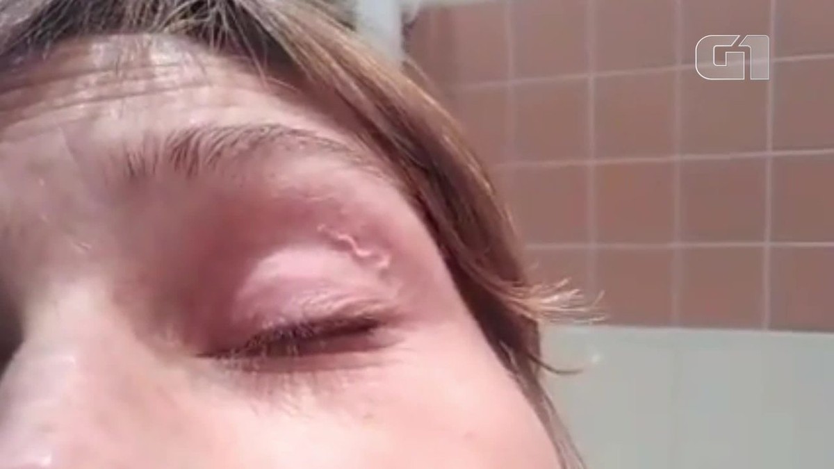 Verme no olho: vídeo mostra caso da loíase, doença rara no Brasil | Ciência e Saúde