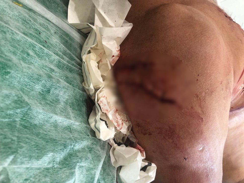 Vtima precisou passar por uma cirurgia na regio ombro. — Foto: Divulgao