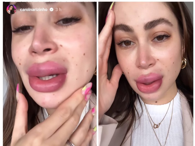 Carol Narizinho mostra boca superinchada após retirar preenchimento labial (Foto: Reprodução/Instagram)