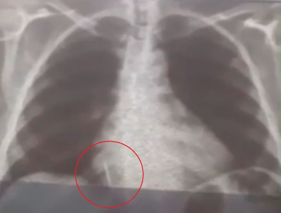 Paciente extrai dente e sai de consultório com broca no pulmão no interior do RN — Foto: Reprodução