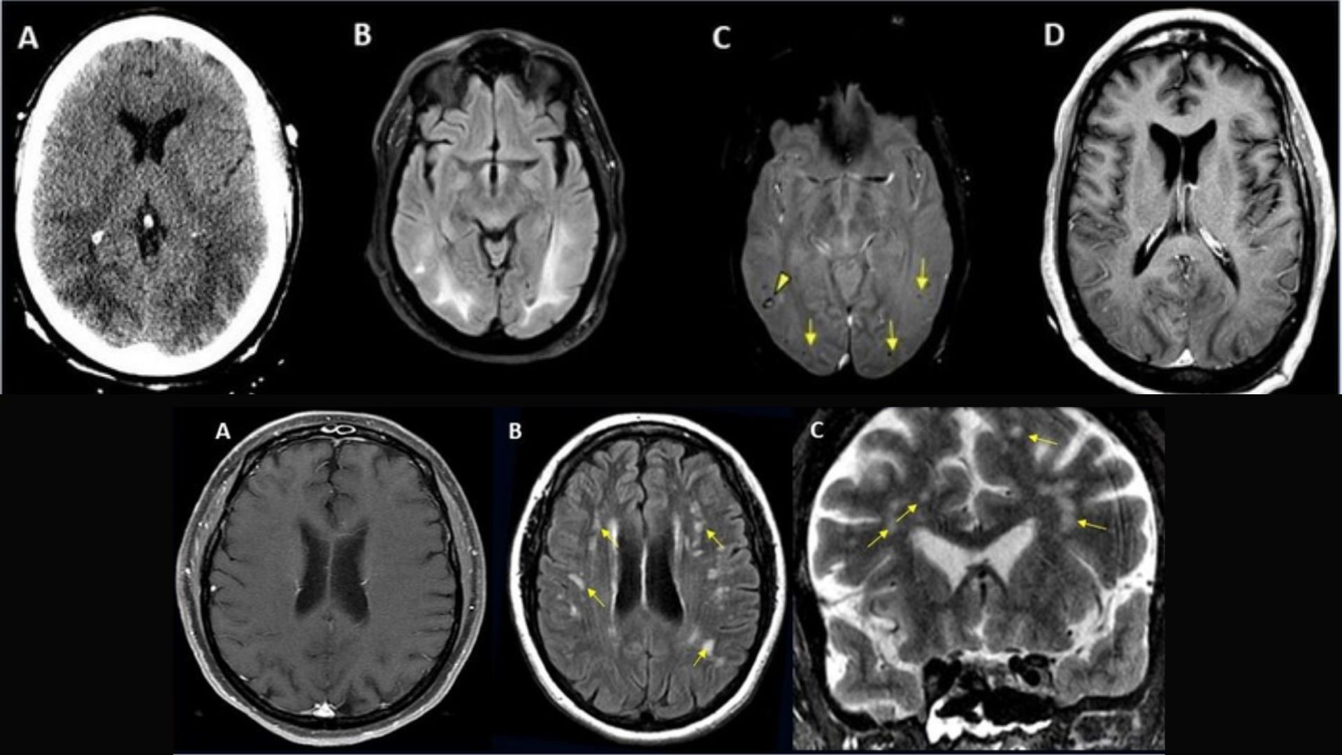 (acima) cérebro de homem de 65 anos, tabagista, com Covid-19 e edema cerebral; (em baixo) cérebro de mulher de 49 anos que desenvolveu cefaleia seguida de tosse e febre  (Foto: Radiological Society of North America and Scott H. Faro, M.D.)