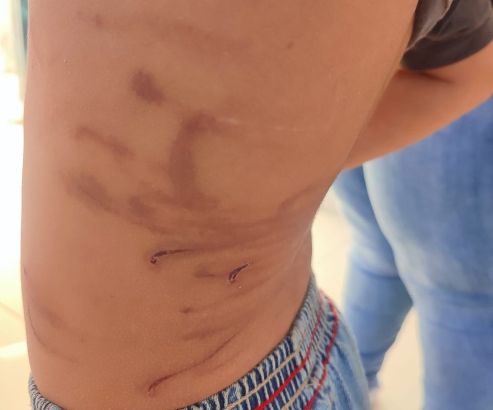 Costas de criança agredida pelo padrasto em Araguari — Foto: g1