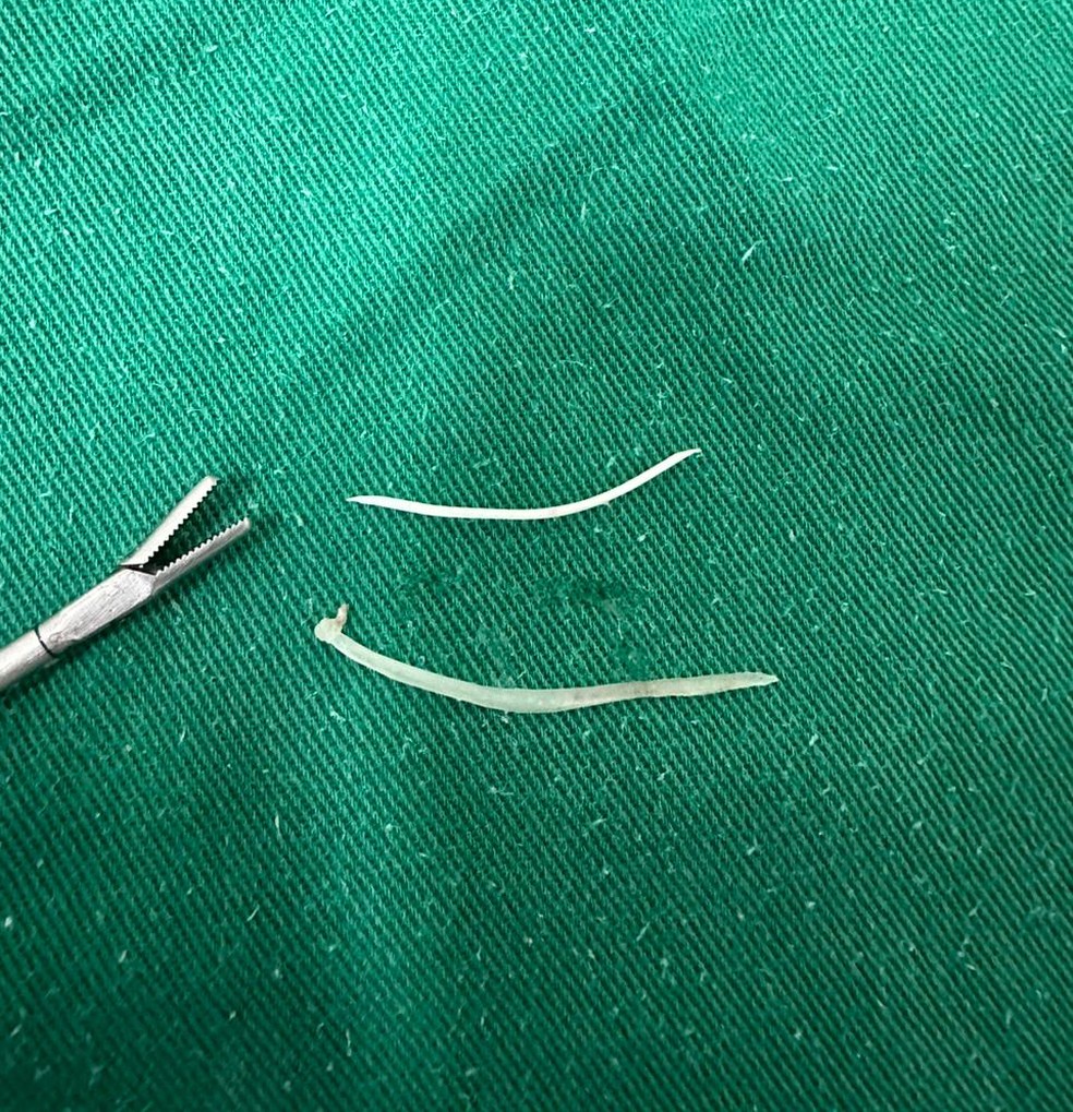 Médico retirou espinhas de peixe de dentro do ouvido de pacientes no PS — Foto: Arquivo pessoal