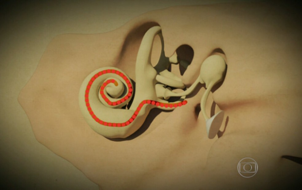 Arte mostra o parelho auditivo e um implante coclear — Foto: TV Globo/Reprodução