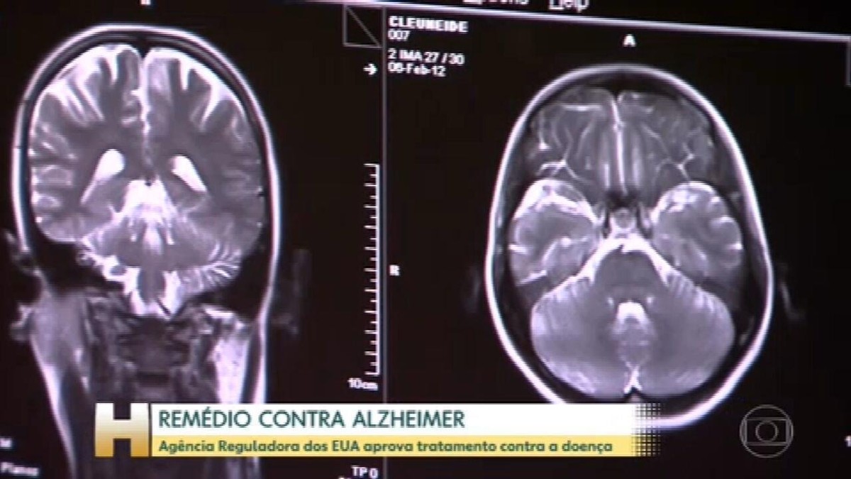 Remédio Contra O Alzheimer é Aprovado Por Agência Dos EUA | Ciência E ...