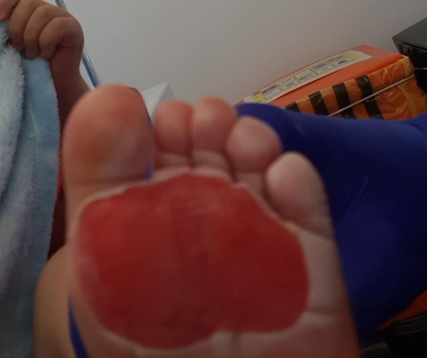 Mãe compartilhou fotos dos pés queimados do filho após andar descalso em piso quente (Foto: Reprodução/Facebook/Natasha Trevethan)