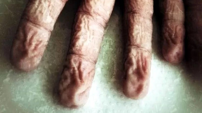 Depois de alguns minutos na água morna, pele da ponta dos dedos fica enrugada como ameixa seca (Foto: Alamy via BBC News)