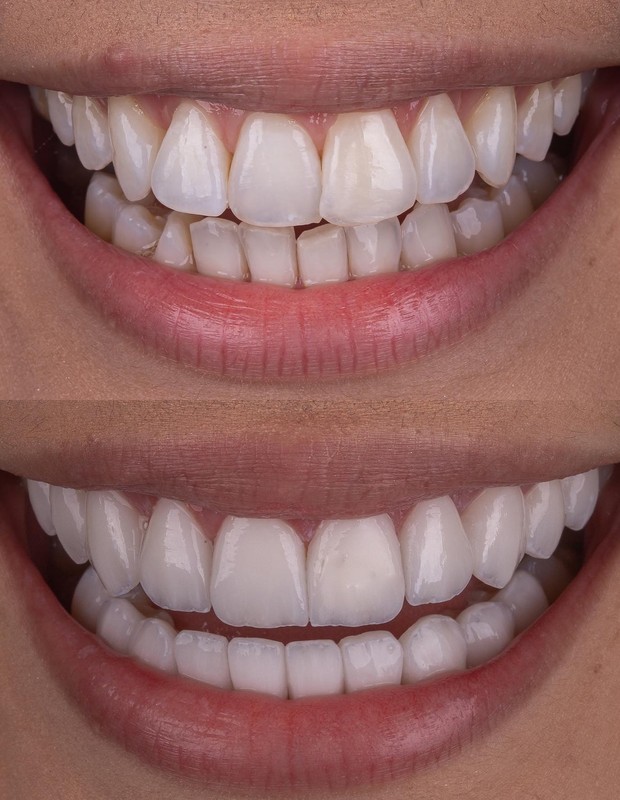 Eslovênia Marques, do BBB22, põe lentes de contato nos dentes (Foto: Reprodução/Instagram)