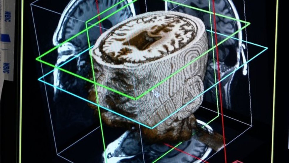 IA pode identificar padrões em tomografias cerebrais que mesmo os neurologistas mais experientes não conseguem ver — Foto: Universidade de Cambridge via BBC