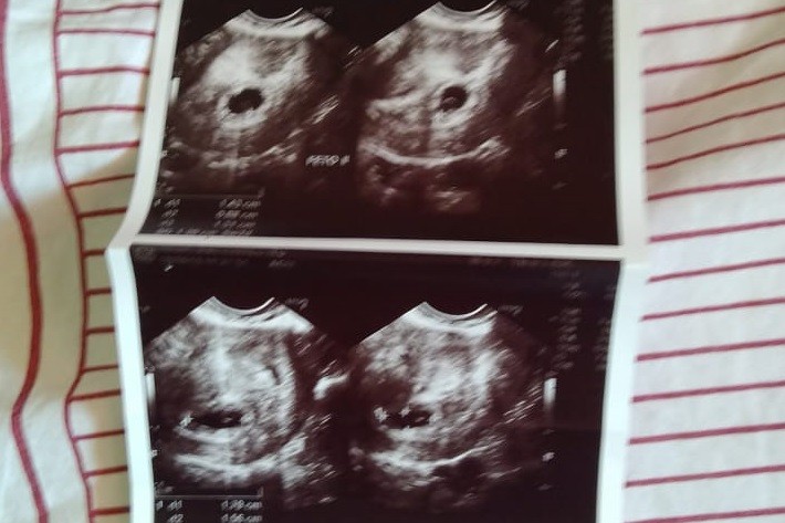 Cibele engravidou de gêmeos usando DIU (Foto: Arquivo pessoal)