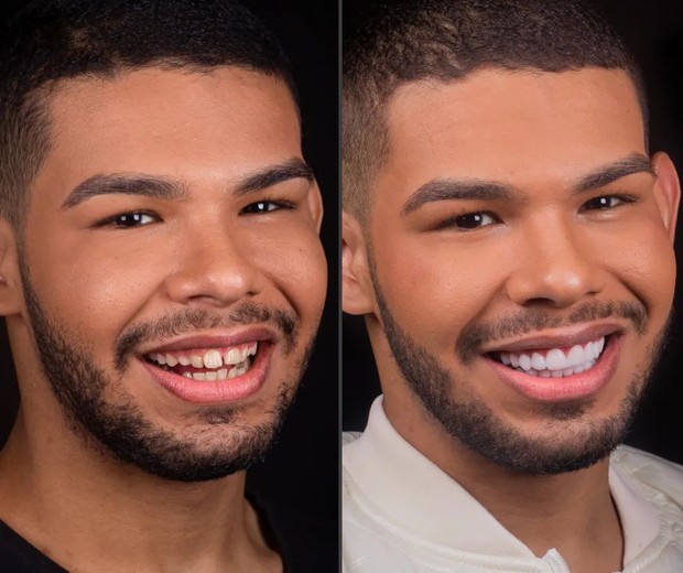 Antes e depois do sorriso de Vyni, do BBB22 (Foto: @drviotto)