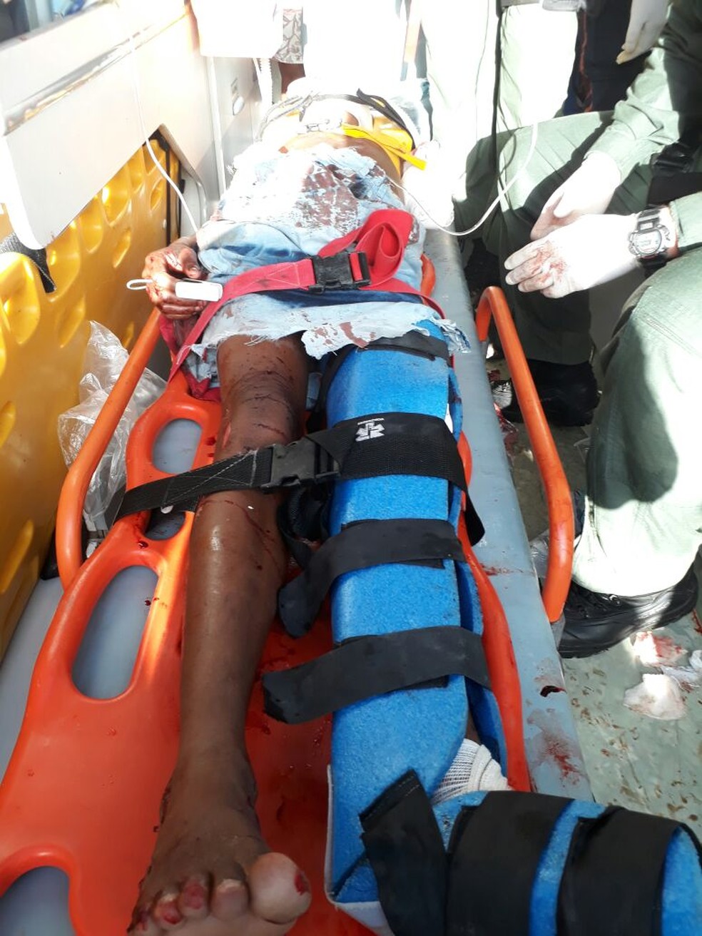 Jovem de 16 anos teve o bra&ccedil;o amputado no acidente, em Porto Calvo (Foto: / Grupamento a&eacute;reo)