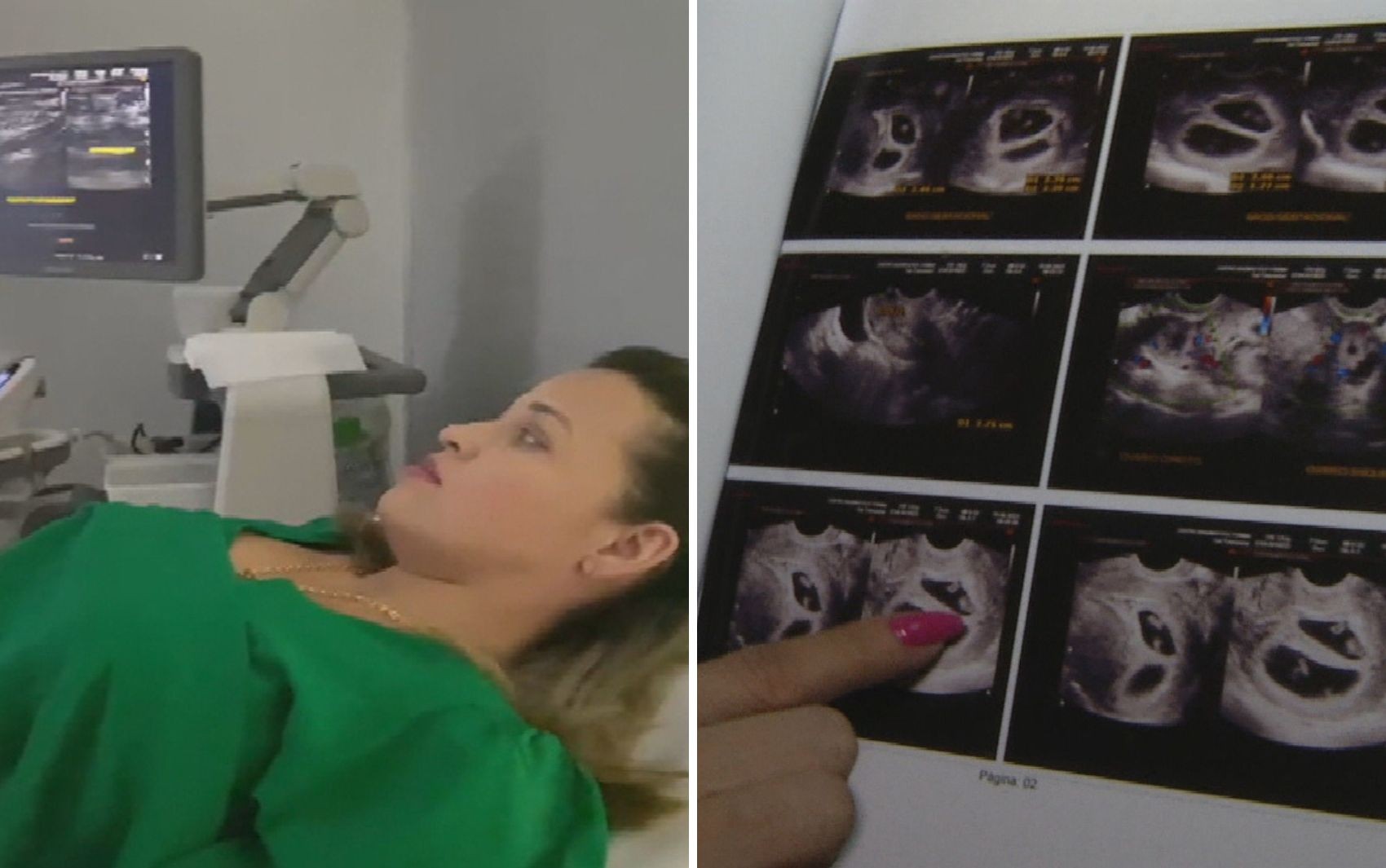 MÃ£e se surpreende ao descobrir gravidez de quadrigÃªmeos durante ultrassom: 'Foi um susto'