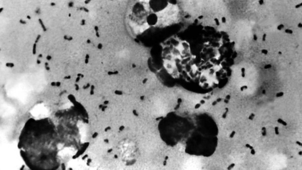 Uma amostra de peste bubônica em tecido removido do gânglio de um paciente — Foto: Getty Images via BBC
