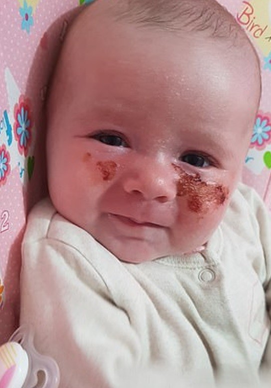 Bebê sofre queimaduras depois de pegar planta tóxica (Foto: Reprodução )