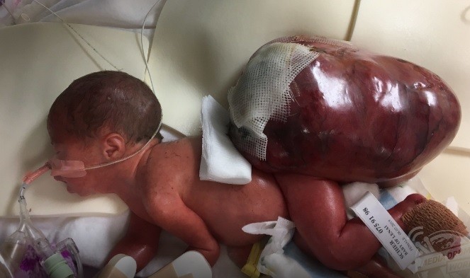 Tumor era mais pesado do que a própria bebê ao nascer (Foto: Reprodução/MDWFEATURES/LENAI SCHIER)