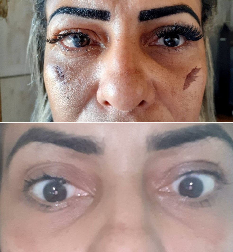 Mulher sofre lesões nos olhos depois de colocar cílios postiços em clínica de estética em Porto Velho — Foto: arquivo pessoal