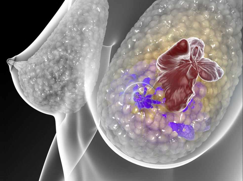 Tumor de mama foi um dos cânceres estudados por pesquisadores. Cientistas acreditam que genoma tem genes específicos de prevenção  (Foto: C. Bickel/Science Translational Medicine)