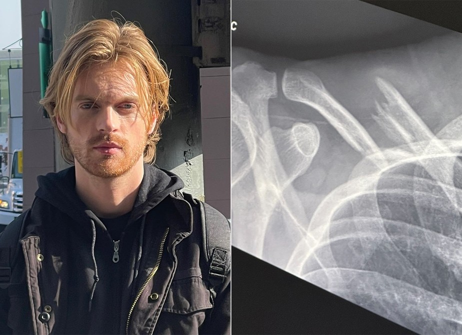 Finneas mostra lesão na clavícula após acidente de bicicleta