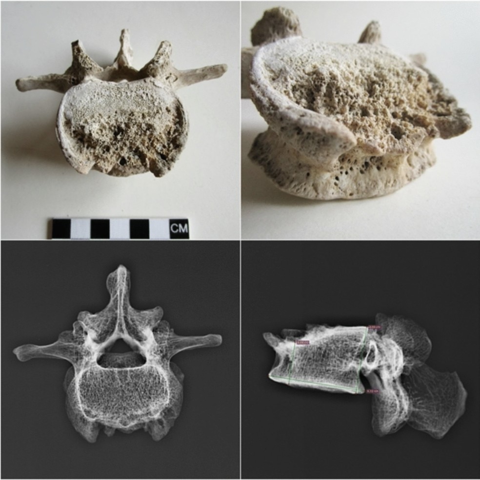 Foto e radiografia de vértebra lombar apontam lesões por espondilodiscite tuberculosa do homem que morreu em Pompeia há quase dois mil anos. — Foto: Reprodução/Nature