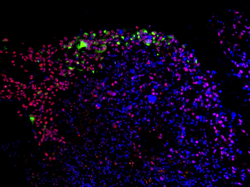 Imagem mostra preferência do zika por células-tronco neuronais. Em verde, mais acima, o vírus Zika visa células-tronco em um glioblastoma humano (câncer cerebral) (Foto: Zhu et al/2017)
