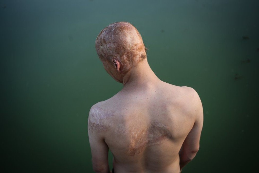 Lyosha sofreu queimaduras na cabeça, ombros e braços — Foto: Pavel Volkov/BBC 