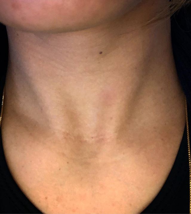 Lucilene Caetano mostra cicatriz praticamente imperceptível no pescoço (Foto: Facebook/Reprodução)