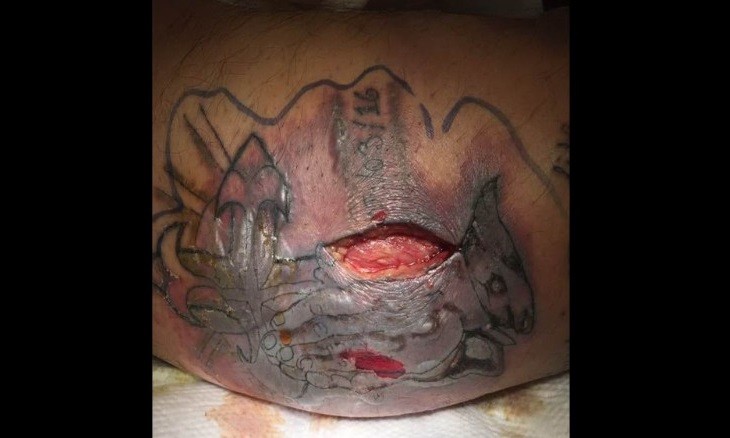 Paciente internado com infecção após tatuagem e banho de mar