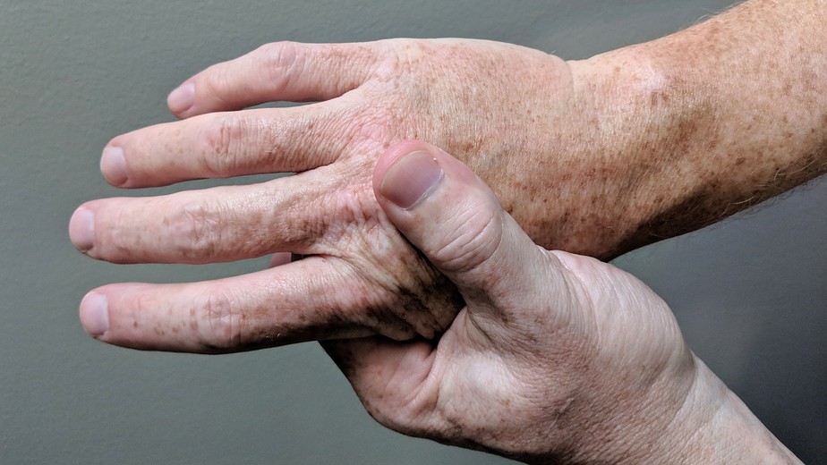 Paciente com artrite reumatoide exibe articulações inflamadas nas mãos