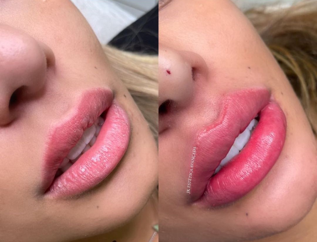 Antes e depois de Rafaella Santos  (Foto: Reprodução/Instagram)
