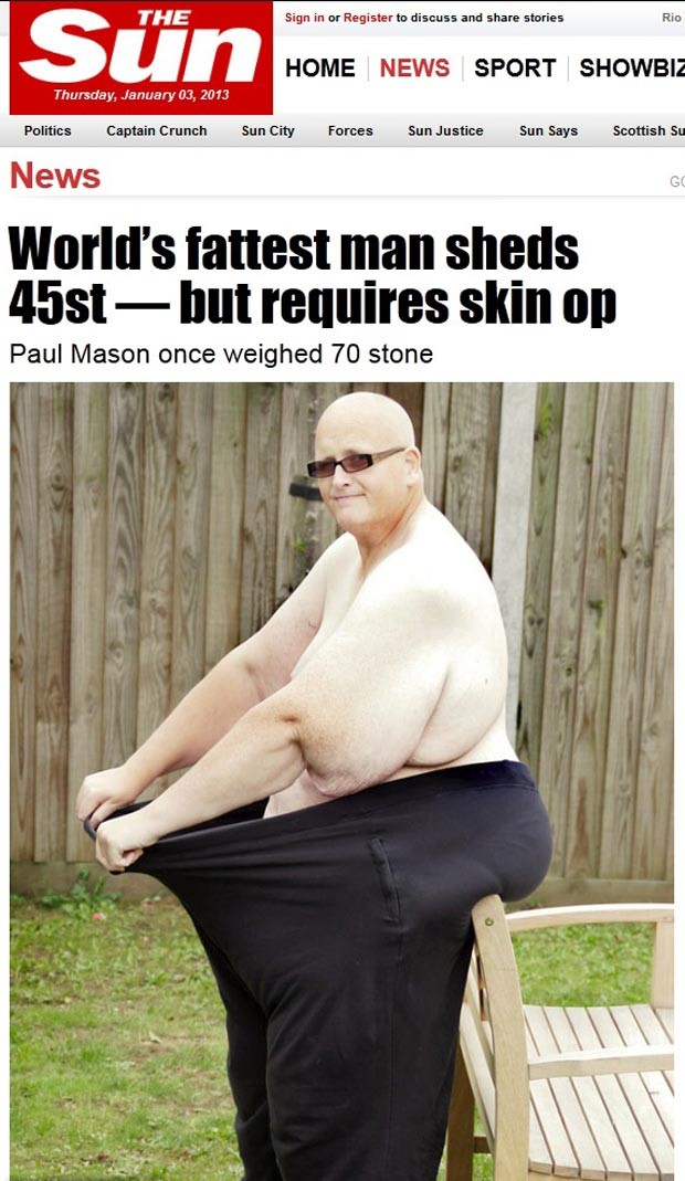 Paul Mason precisa de cirurgia para remover a pele que restou (Foto: Reprodução/The Sun)
