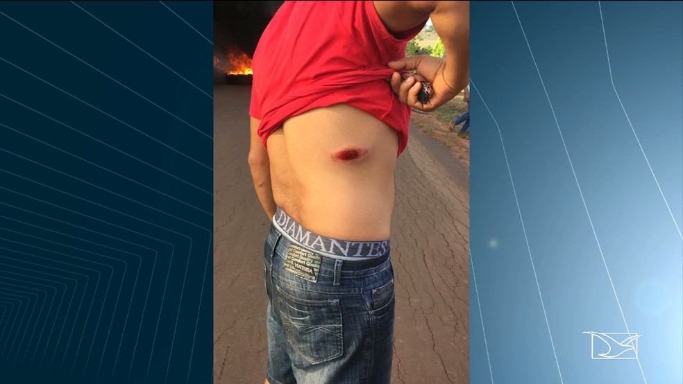 Manifestante teve ferimento na costela apÃ³s receber um tiro de bala de borracha â Foto: ReproduÃ§Ã£o/TV Mirante
