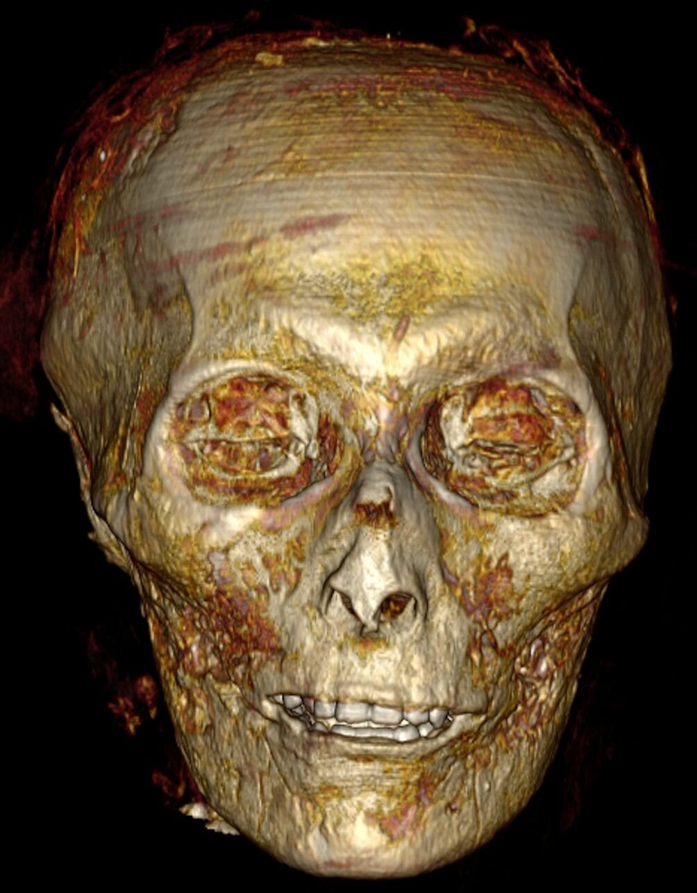 O crânio do faraó Amenófis I revela os dentes dele em boas condições de conservação (Foto: S. Saleem and Z. Hawass)